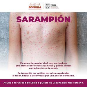 Refuerzan medidas preventivas ante el sarampión
